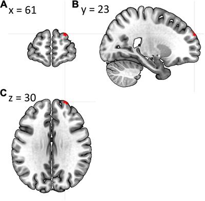 Brain Under Fatigue – Can Perceived Fatigability in Multiple Sclerosis Be Seen on the Level of Functional Brain Network Architecture?